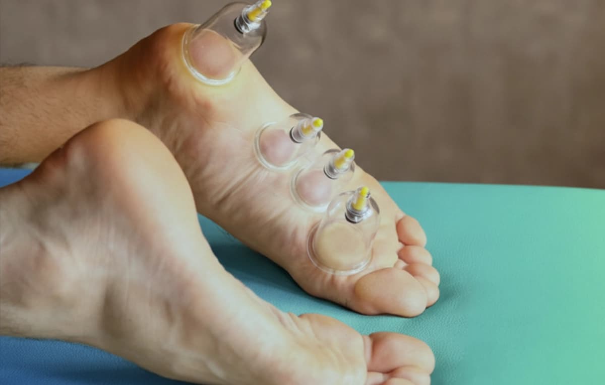 Cupping Therapy