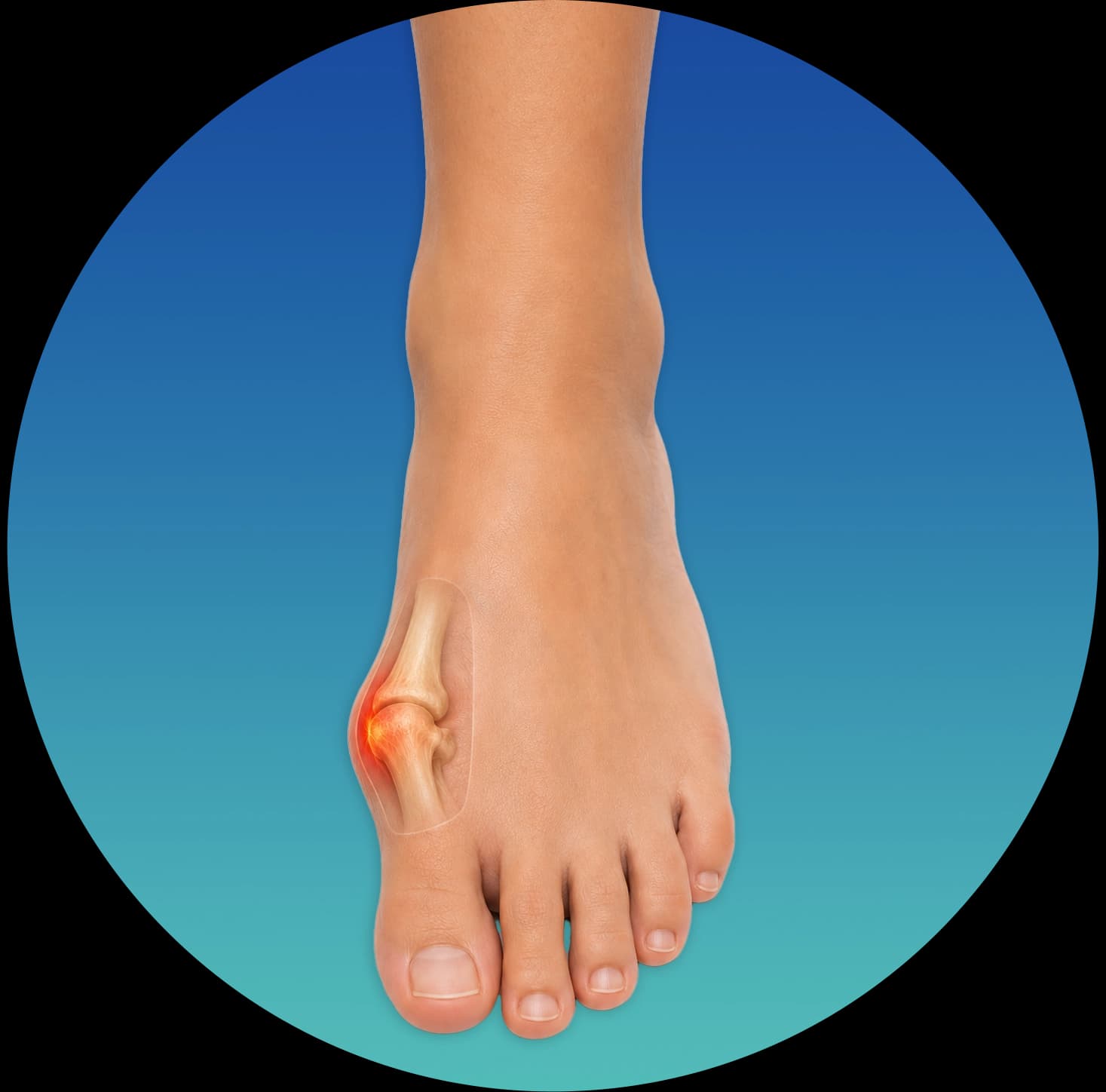 Bunion — bony bump at the base of the big toe joint