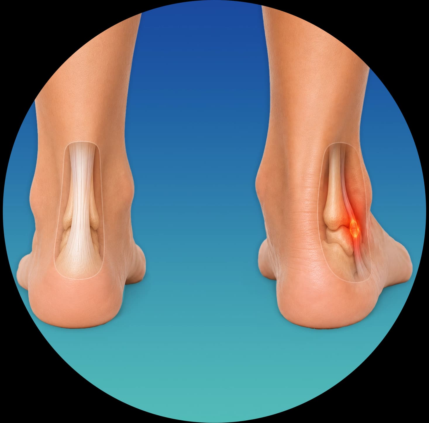 Overpronation — inward rolling of the foot affecting arch and alignment