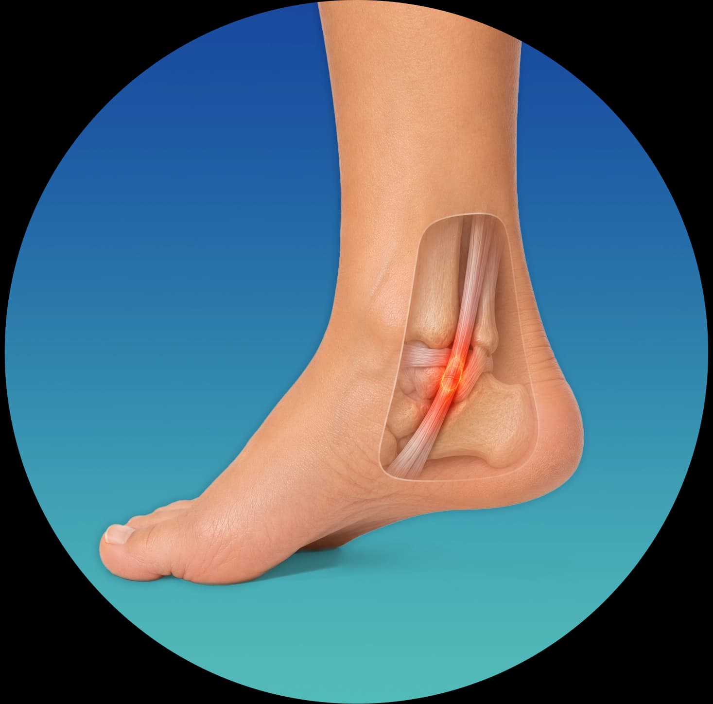 Posterior tibial tendonitis — tendon running behind the inner ankle